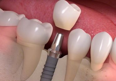 Dental implants in dhakoli,