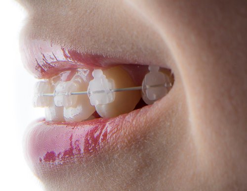Dental implants in dhakoli,