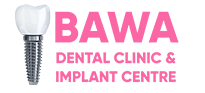 Dental implants in Chandigarh,