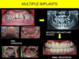 Dental implants in Zirakpur,