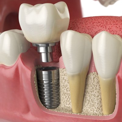 Dental implants in Chandigarh,