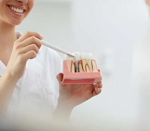 Dental Implants in Mohali