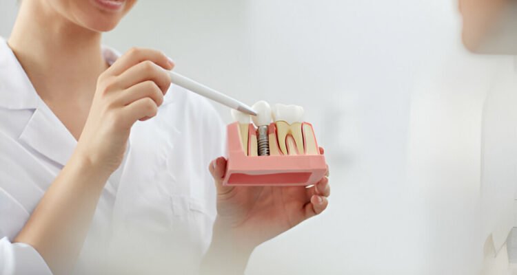 Dental Implants in Mohali
